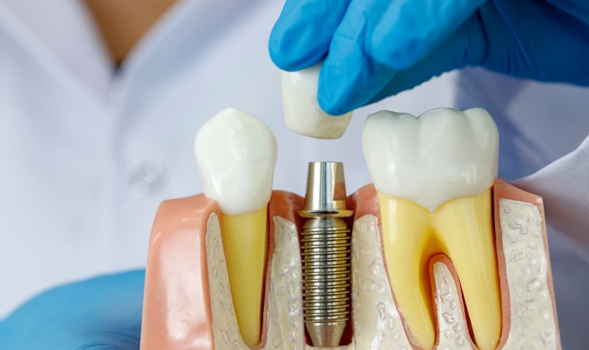dental implants silver spring