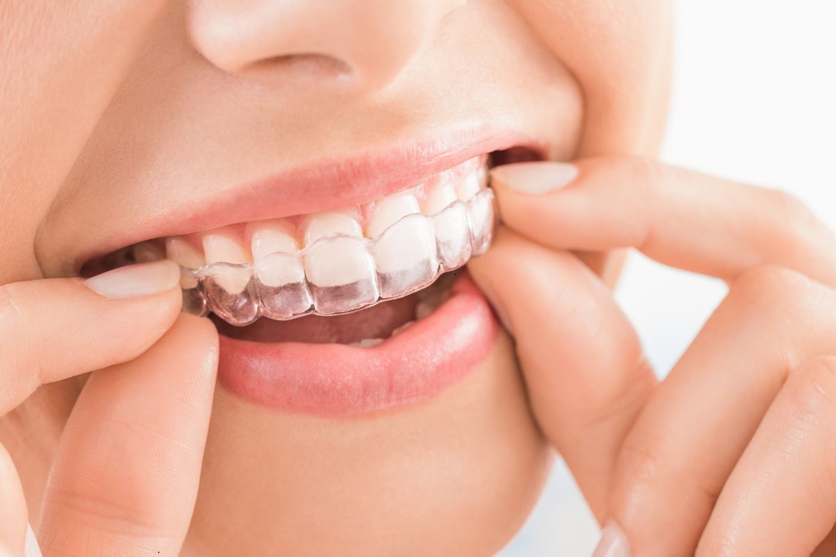 Comfortable Invisalign treatments in Silver Spring