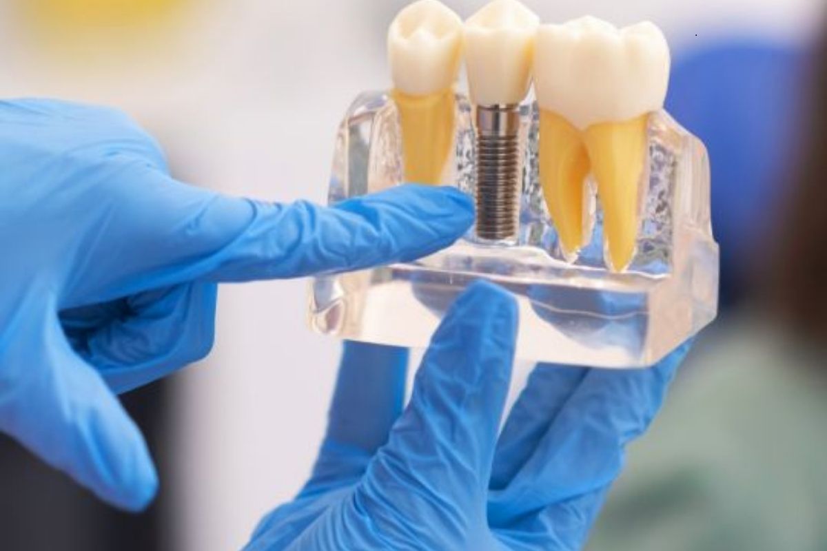 dental implants