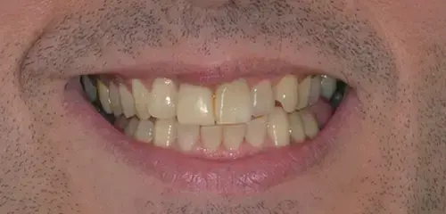 img before