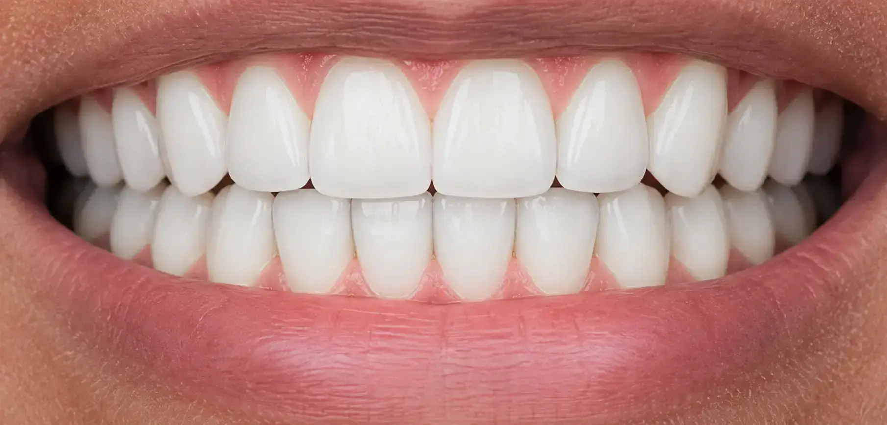 img invisalign after