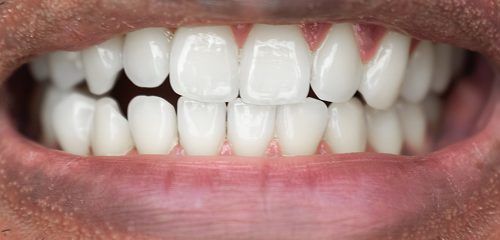 img invisalign before