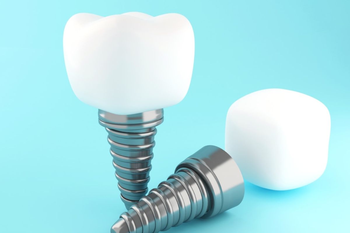 dental implants silver spring