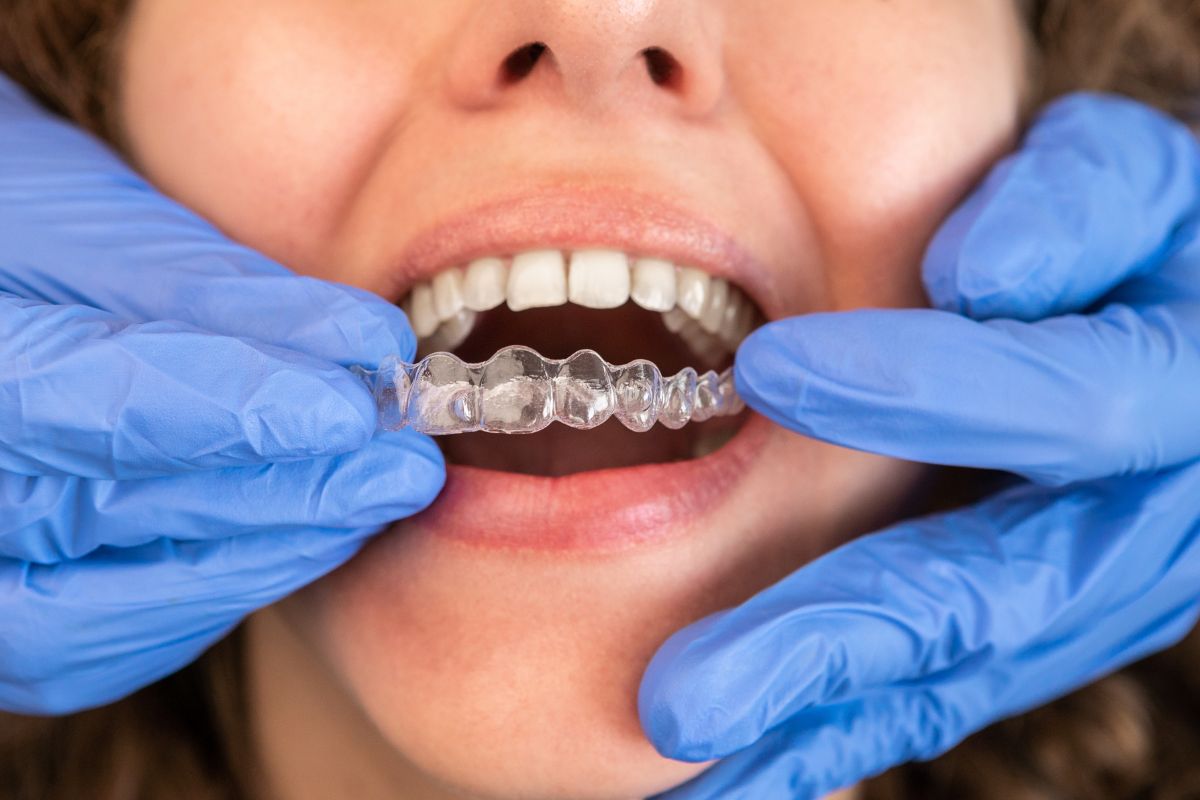 Invisalign in Silver-Spring