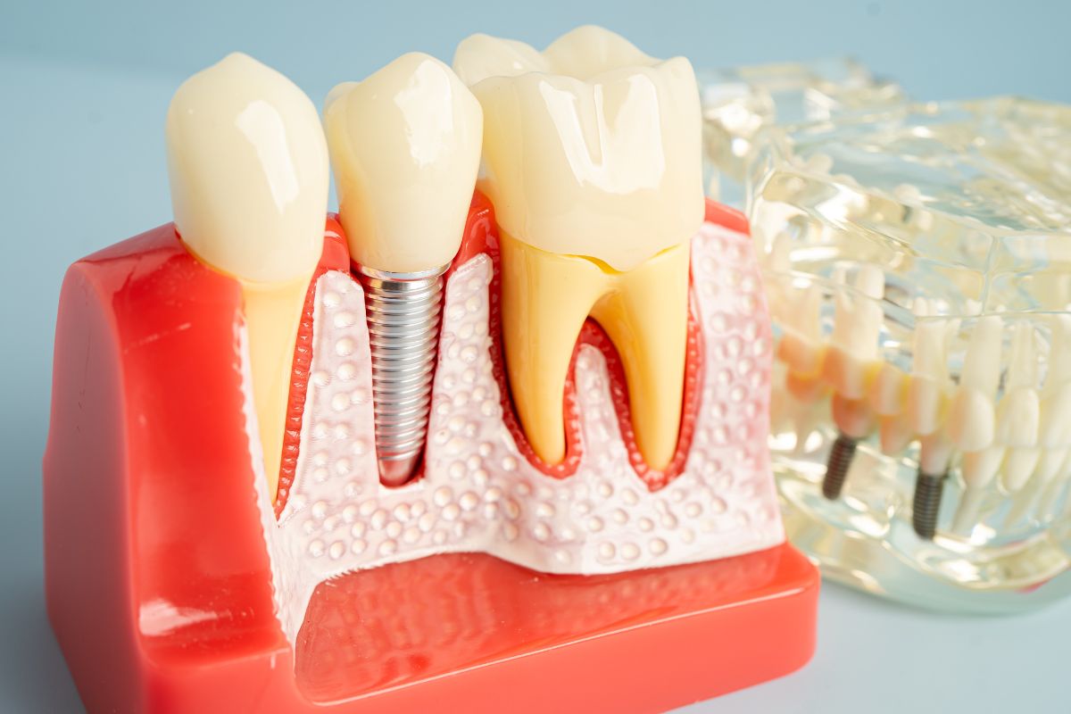 flossing tips for long-lasting dental implants Silver Spring