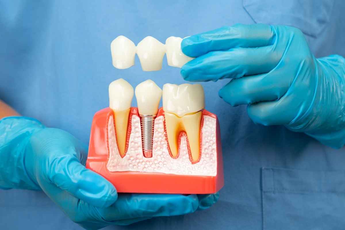 Getting Dental Implants Painful? Myths vs. Facts