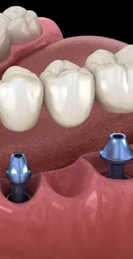 Dental implants with abutments in jawbone model showing tooth replacement solution.