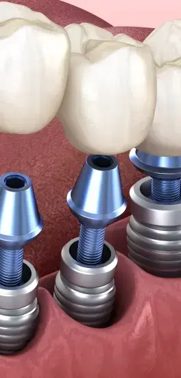 Dental implant components showing titanium posts and abutments with ceramic crowns above.
