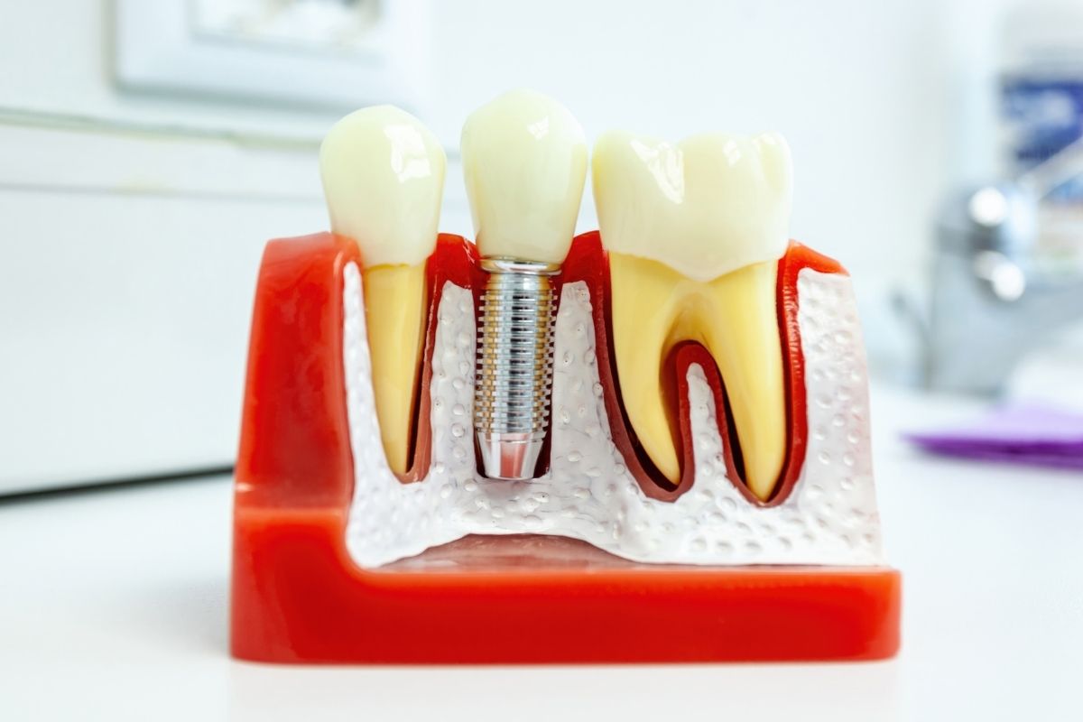 dental implants silver spring