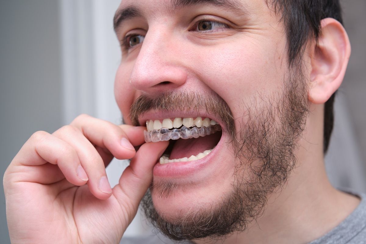 invisalign silver spring